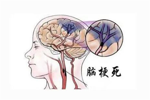 脑梗是什么引起的?发病原因较多(临床常见病症)